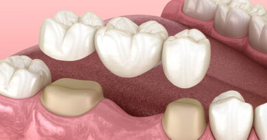 Teeth Bridge Treatment in Lahore