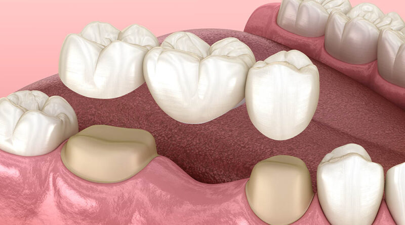 Teeth Bridge Treatment in Lahore