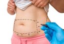 Tummy Tuck in dubai