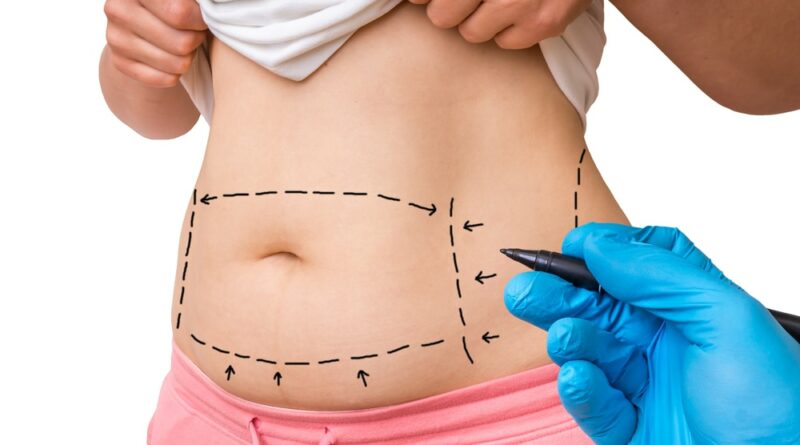 Tummy Tuck in dubai