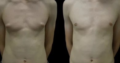 Gynecomastia in Dubai