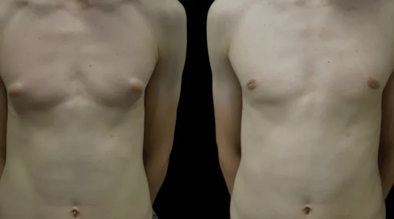 Gynecomastia in Dubai