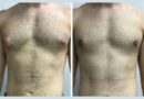 Best Gynecomastia Surgeons in Dubai