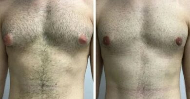 Best Gynecomastia Surgeons in Dubai