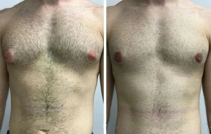 Best Gynecomastia Surgeons in Dubai