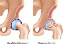 Osteoarthritis vs. Rheumatoid Arthritis: Understanding the Key Differences and Impact on Joint Health