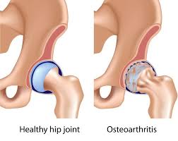 Osteoarthritis vs. Rheumatoid Arthritis: Understanding the Key Differences and Impact on Joint Health