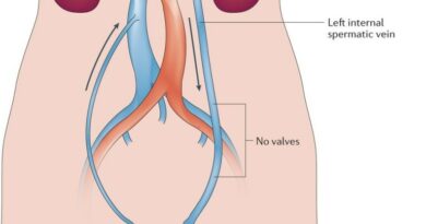 varicocele embolisation