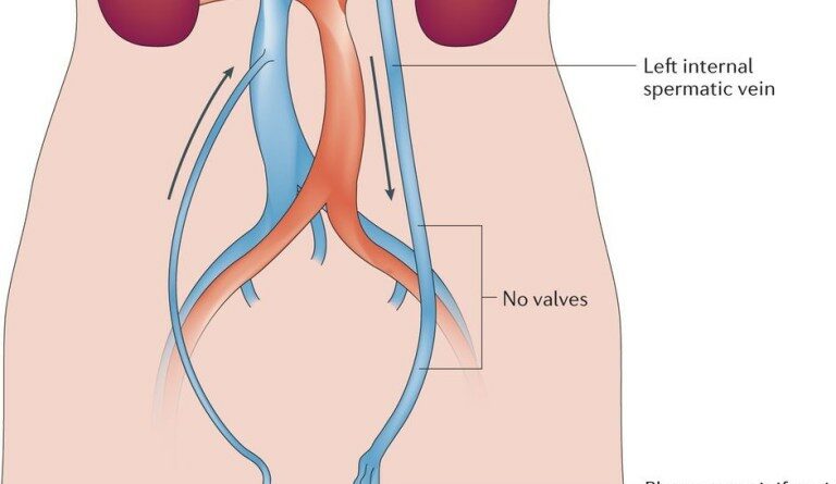 varicocele embolisation