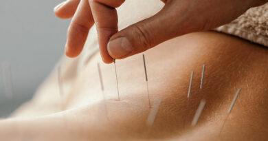 Acupuncture