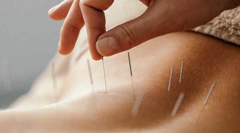 Acupuncture