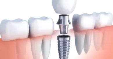 dental implants cost