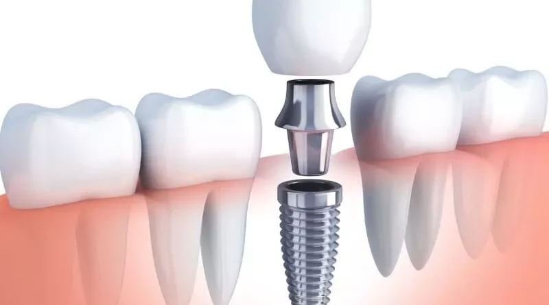 dental implants cost