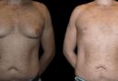 gynecomastia surgery in dubai