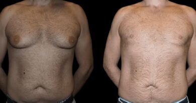 gynecomastia surgery in dubai