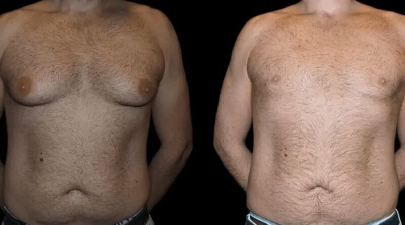 gynecomastia surgery in dubai