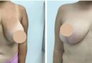 breast lift in dubai