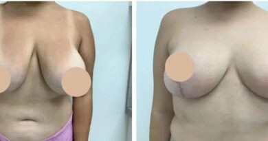 breast lift in dubai