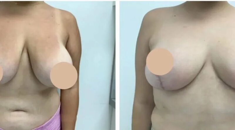 breast lift in dubai