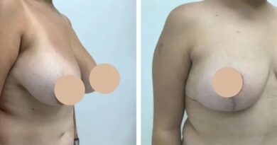 breast reduction in dubai